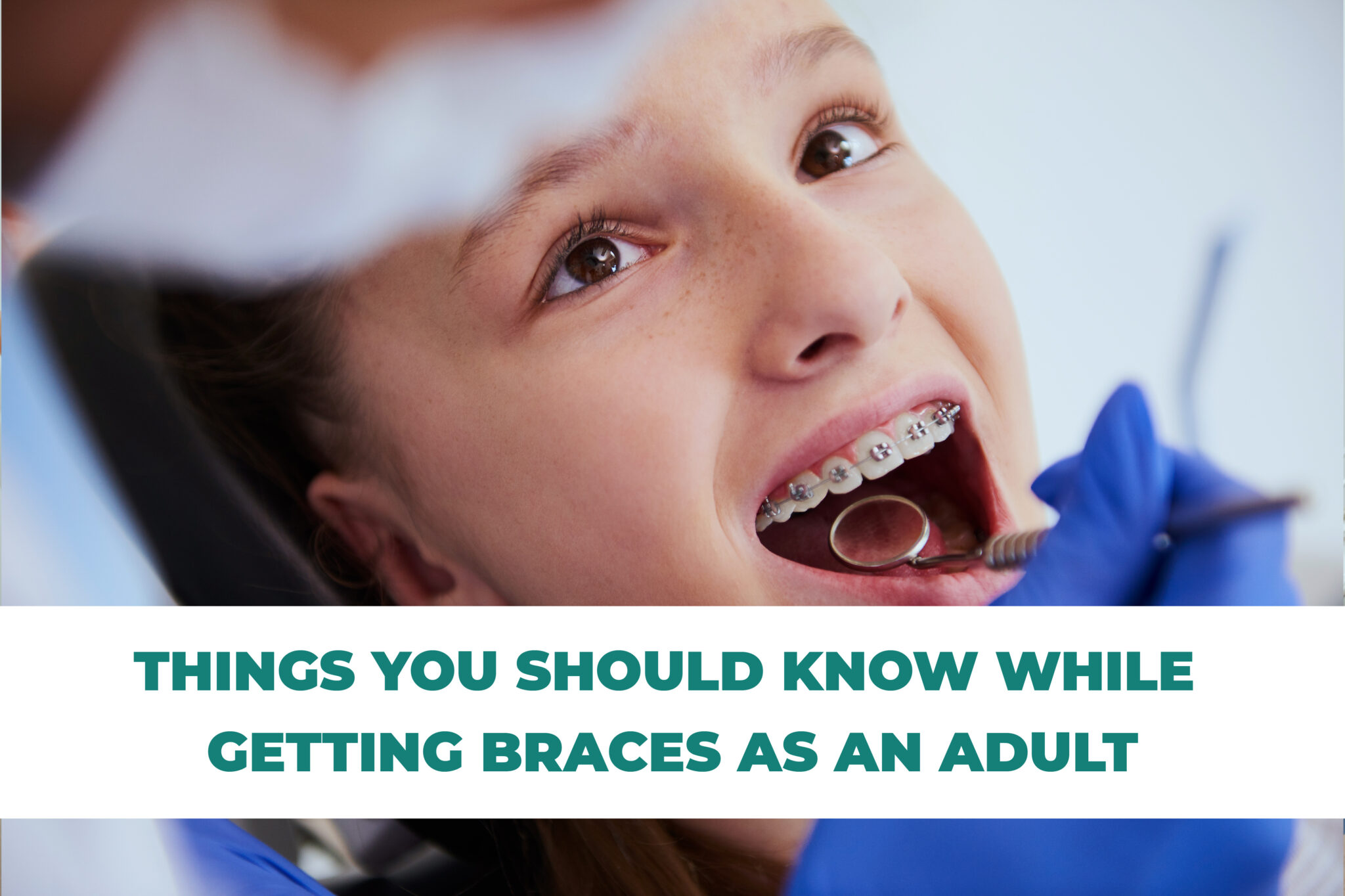 THINGS YOU SHOULD KNOW WHILE GETTING BRACES AS AN ADULT