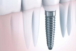 Dental Implants