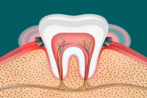 Gum Disease