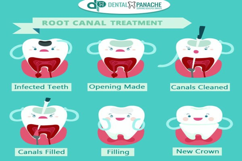 Post RCT Restoration