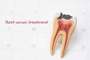 Root Canal Treatment