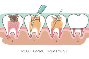 Root Canal Treatment