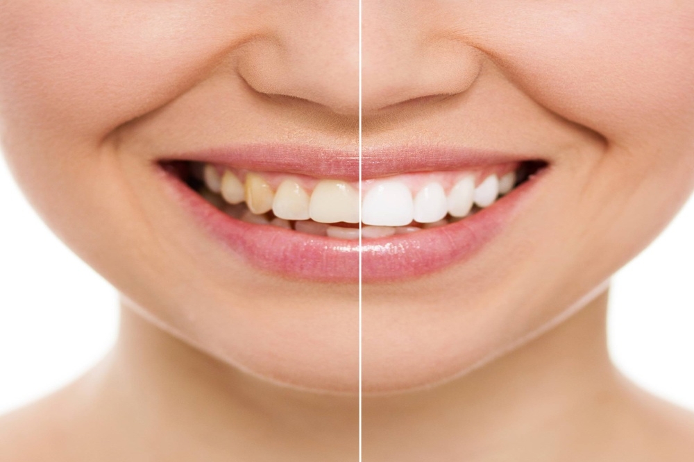 Teeth Whitening