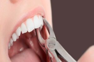 Tooth Extraction