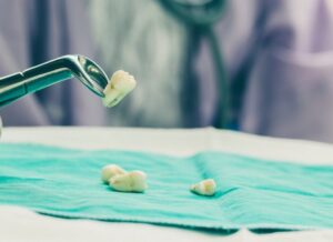 Tooth Extraction