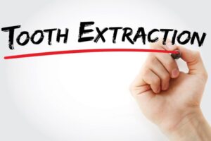 Tooth Extraction and Root Canal Treatment