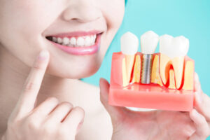 Dental Implants