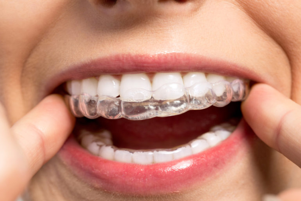 Invisible Braces
