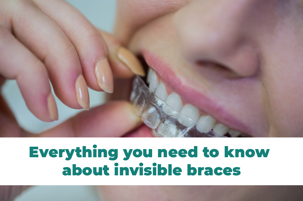 Invisible Braces