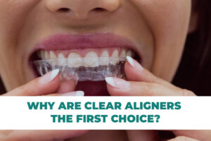 Clear Aligners