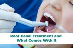 Root Canal Treatment (RCT)