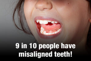 9 in 10 people have misaligned teeth