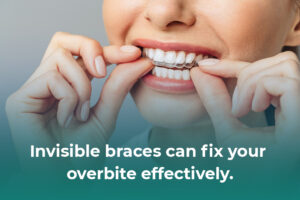 Invisible braces can fix your overbite effectively.