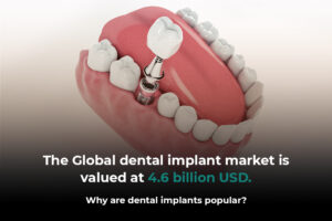 The Global dental implant market is valued at 4.6 billion USD. Why are dental implants popular