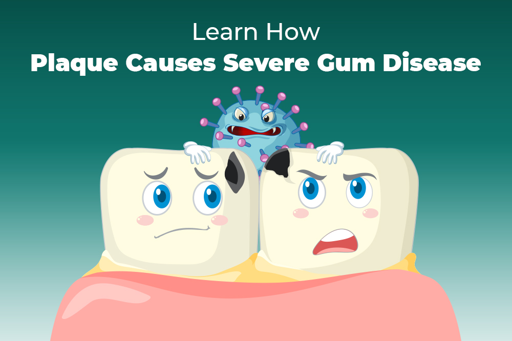 Learn How Plaque Causes Severe Gum Disease