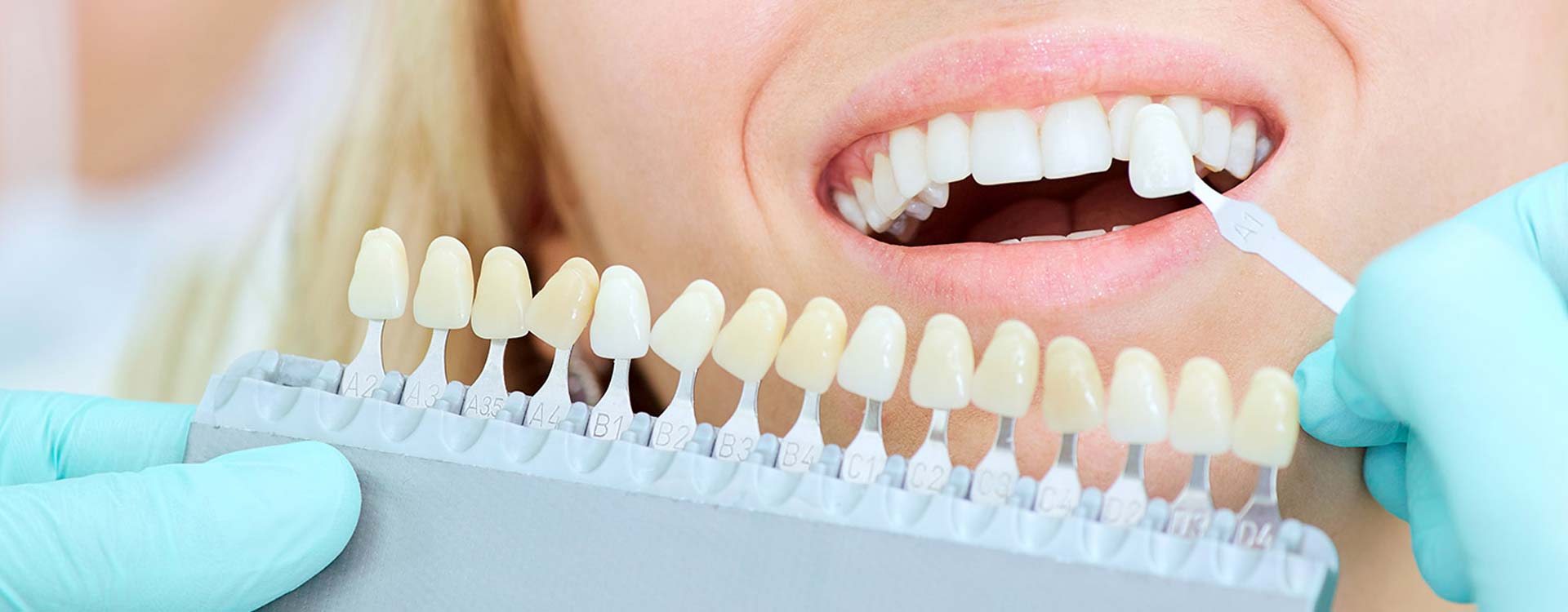 dental crowns and bridges